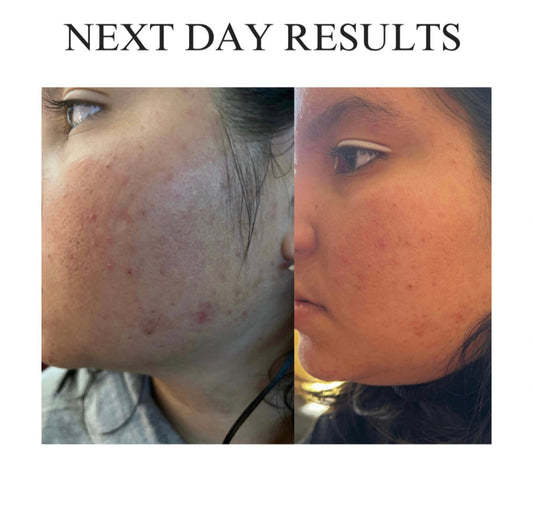 Kloud 9- 3 Step Clear Complexion Skin Set